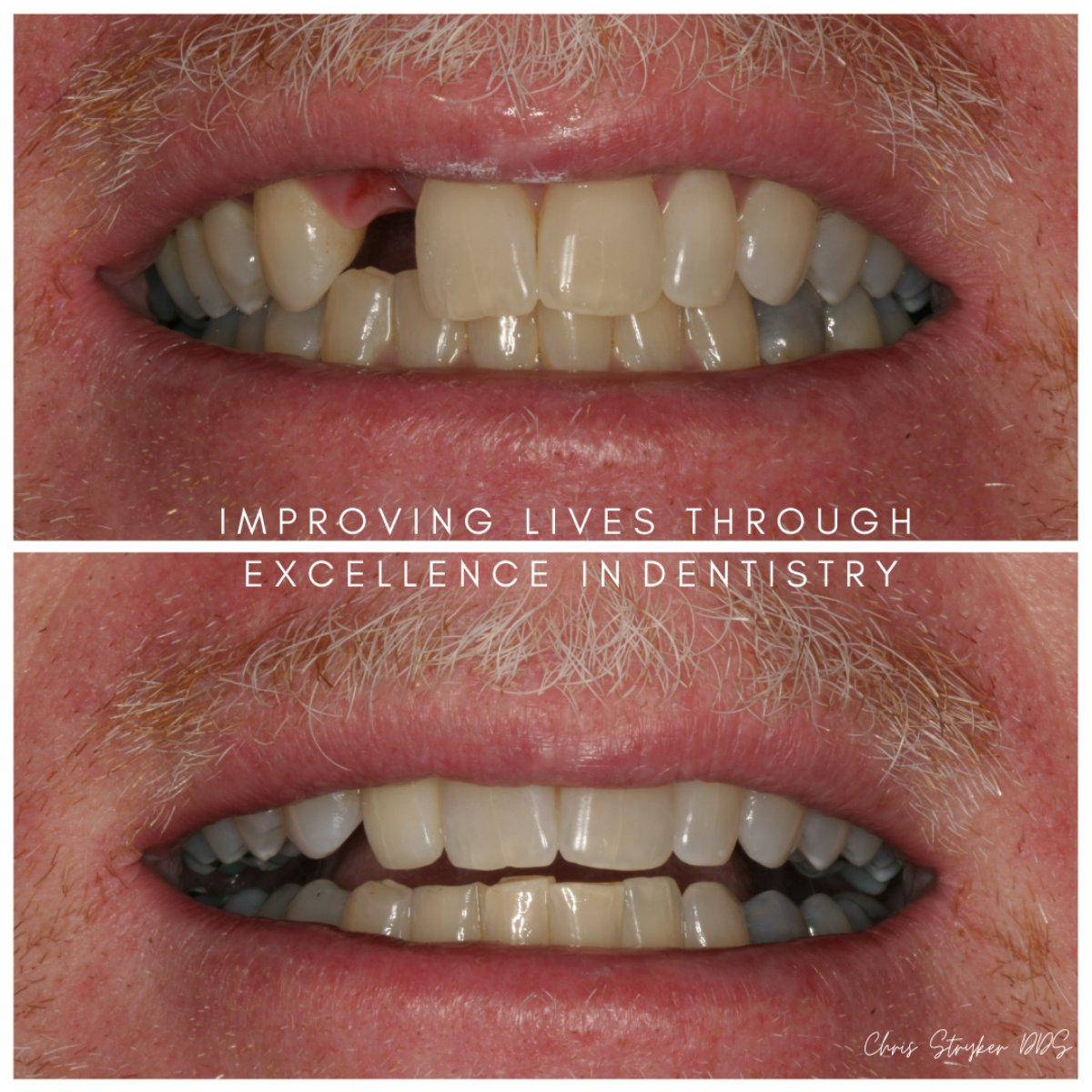 Dental Implants