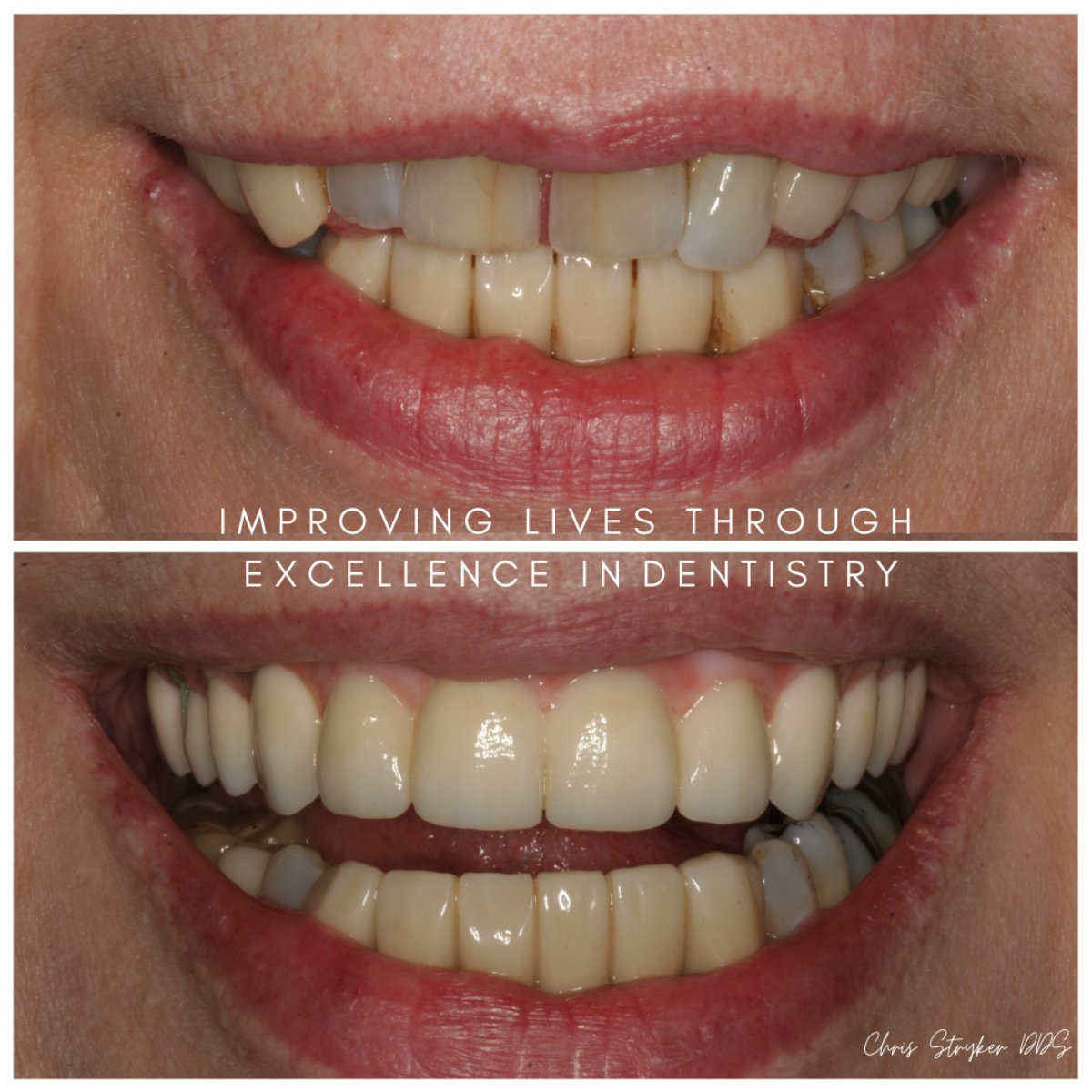 Dental Implants