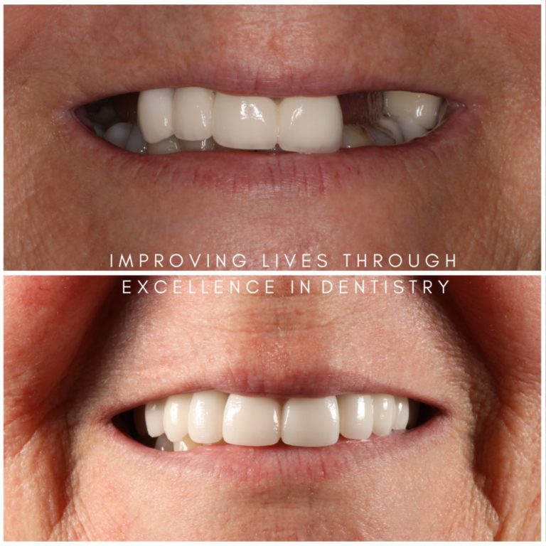 Dental Implants