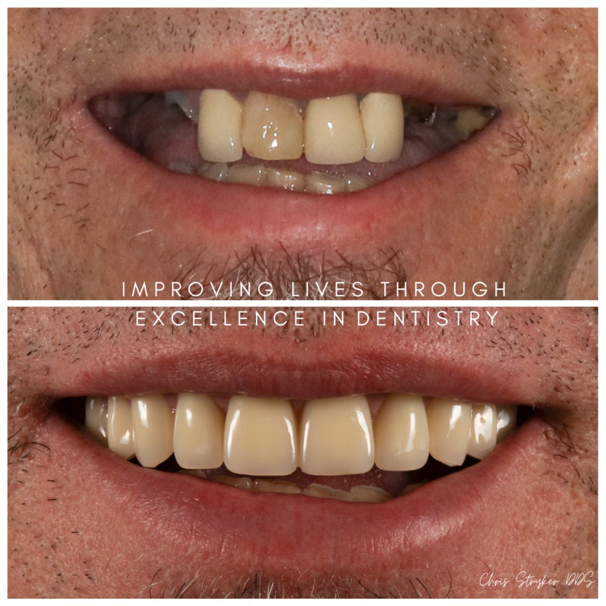 Dental Implants