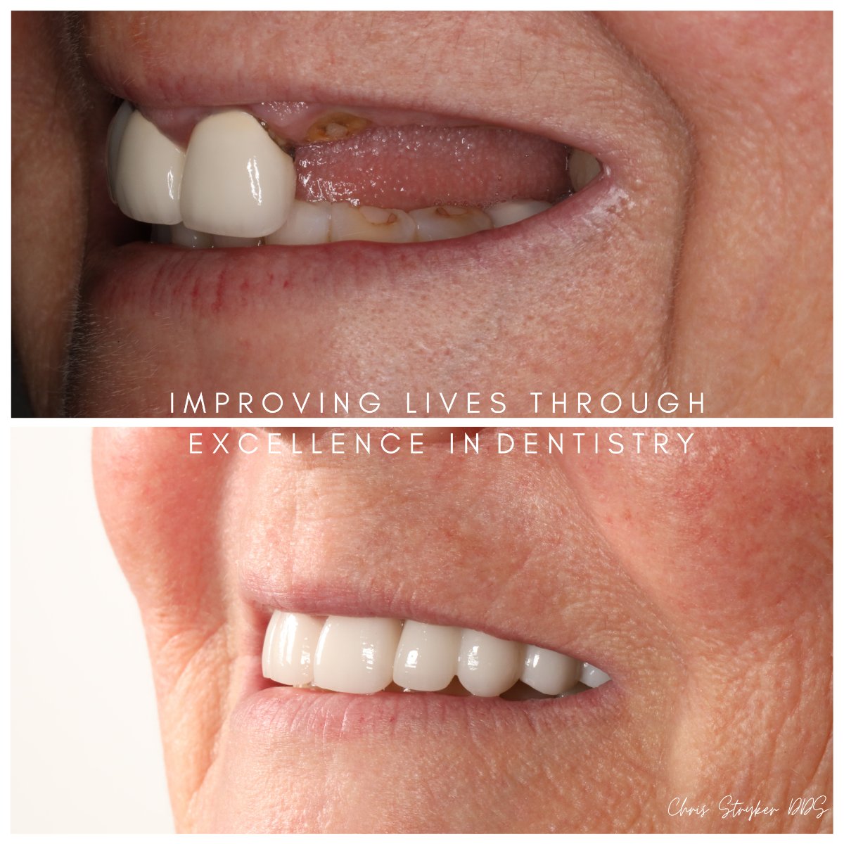 Dental Implants