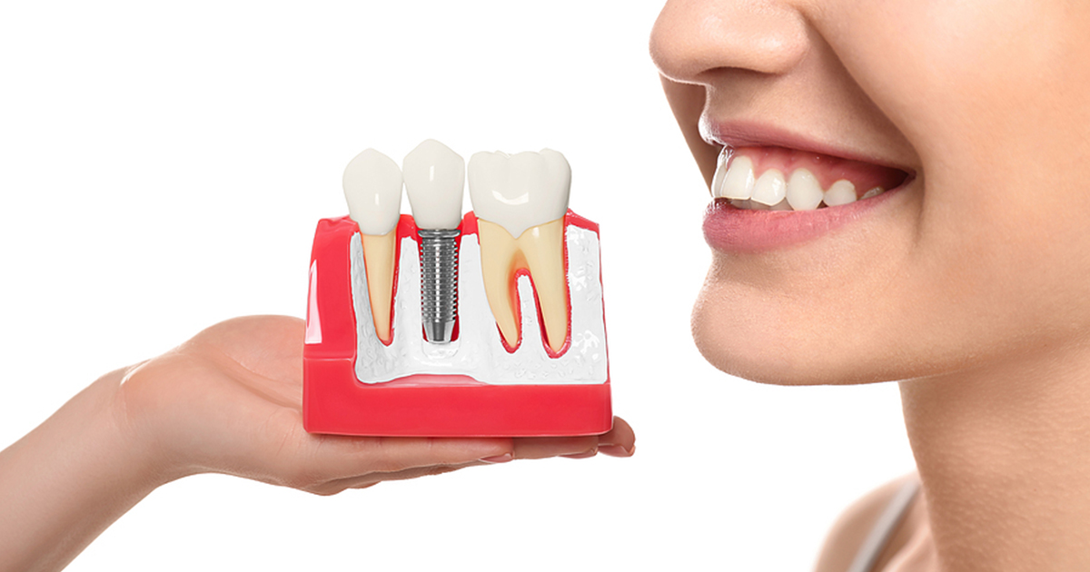 Full Arch Dental Implants All-on-4 Lincoln Crossings Dental Care - Full Arch Dental Implants All-on-4