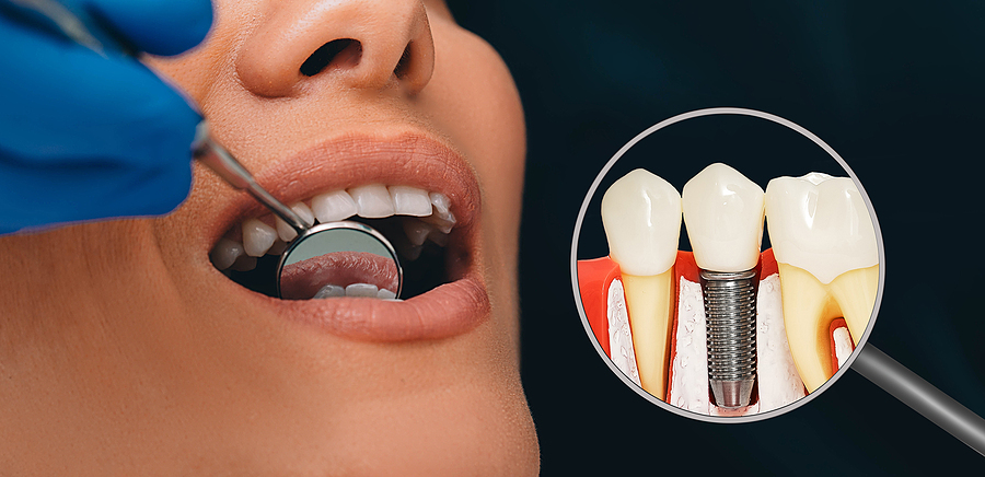 Dentistry, Dental Prosthetics Advertising. Dental Implant Near T Lincoln Crossings Dental Care - Immediate Implants