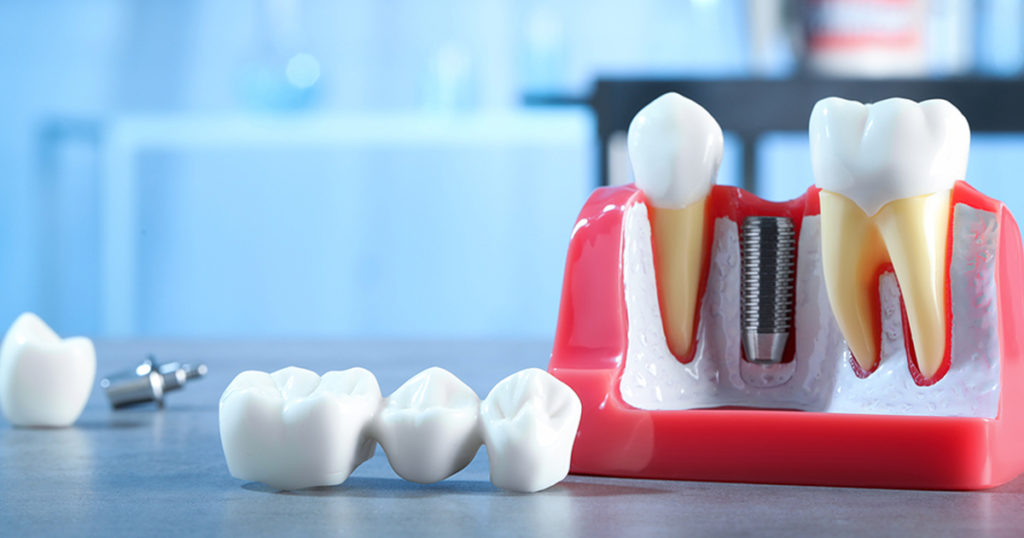 Immediate Implants Lincoln Crossings Dental Care