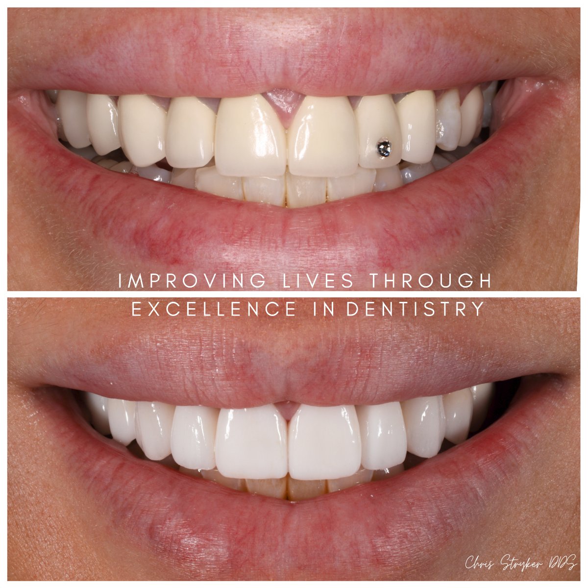 Smile Makeover