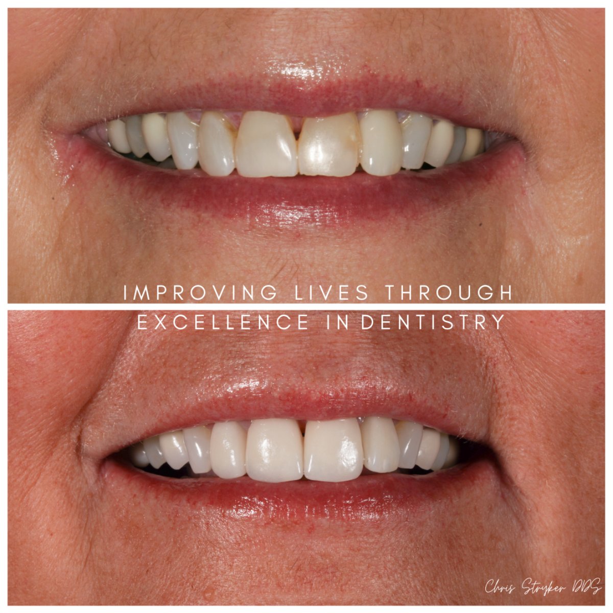 Smile Makeover