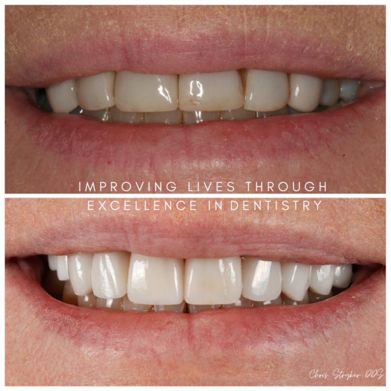 Smile Makeover