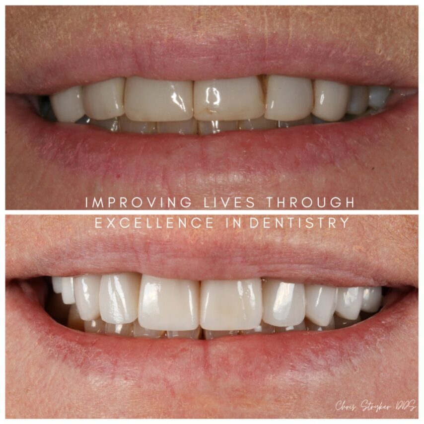Smile Makeover