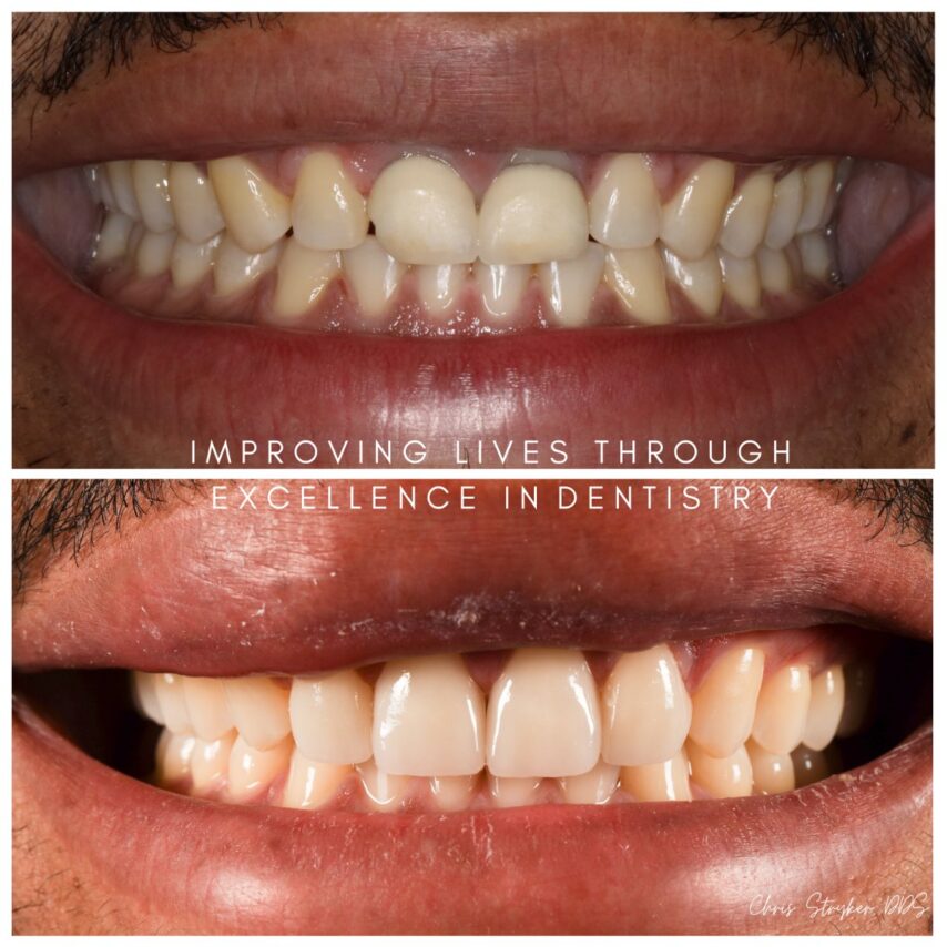Smile Makeover