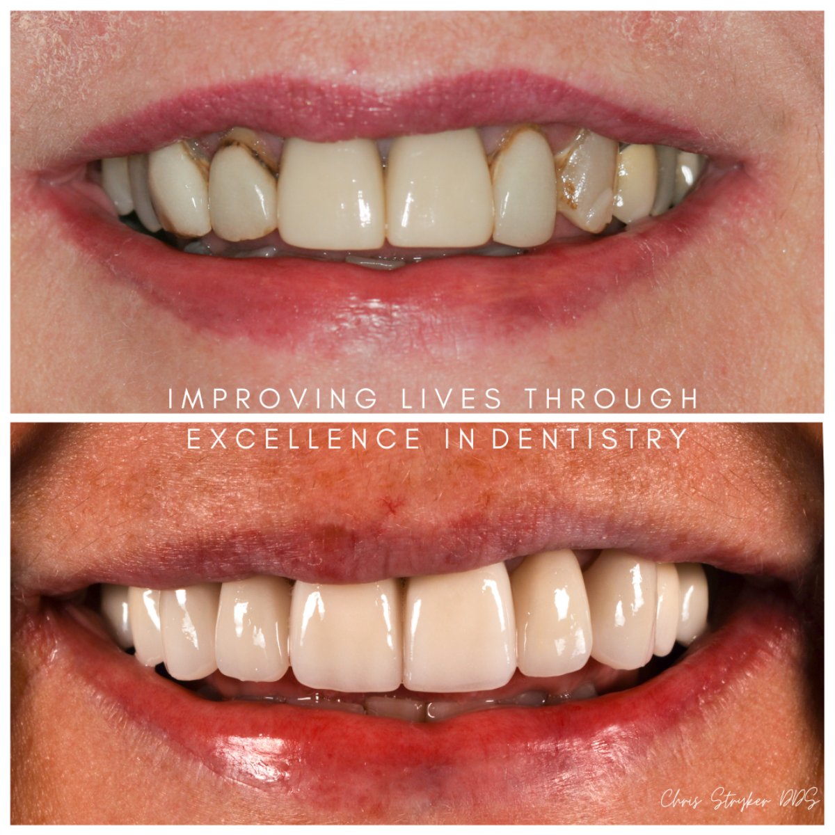 Smile Makeover