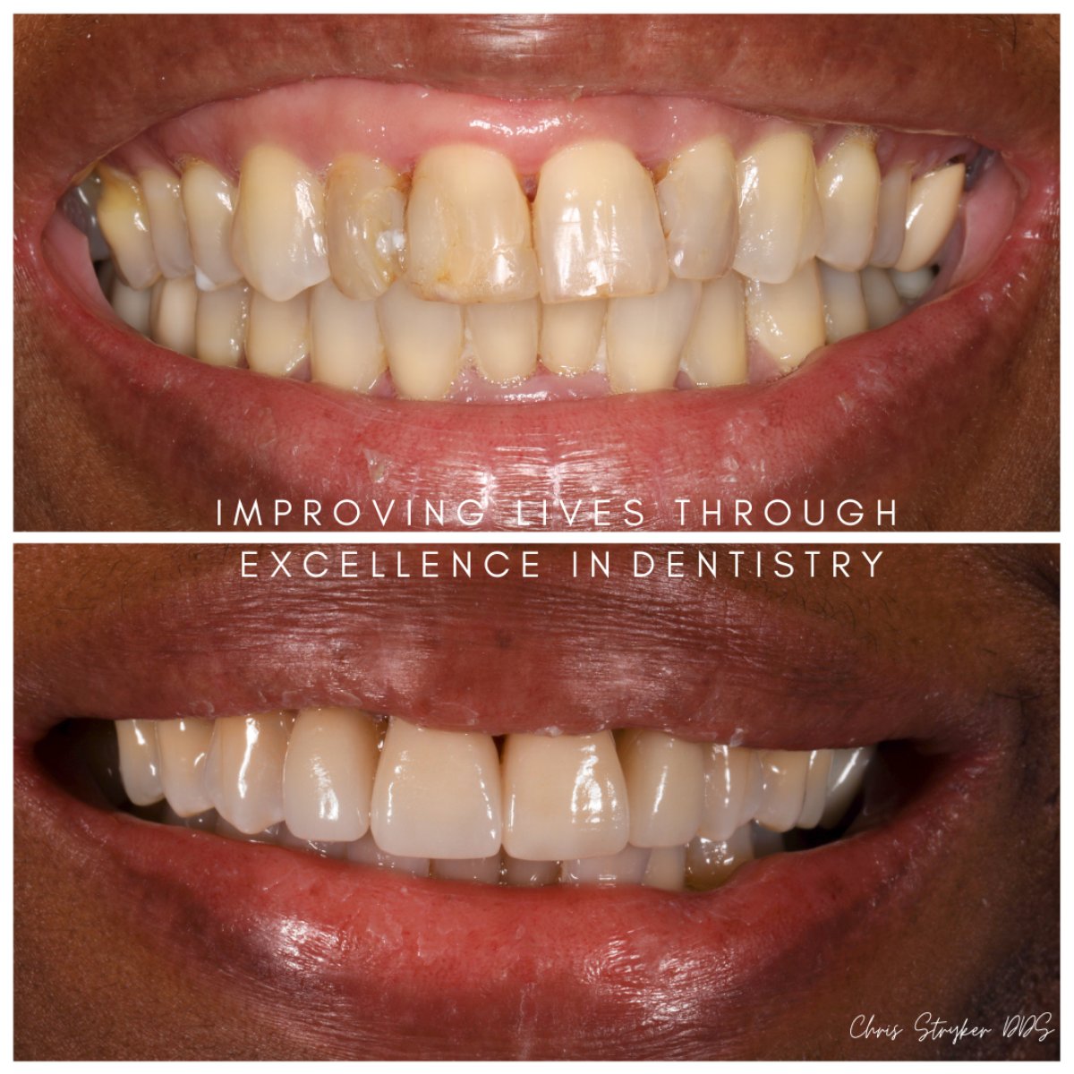 Smile Makeover