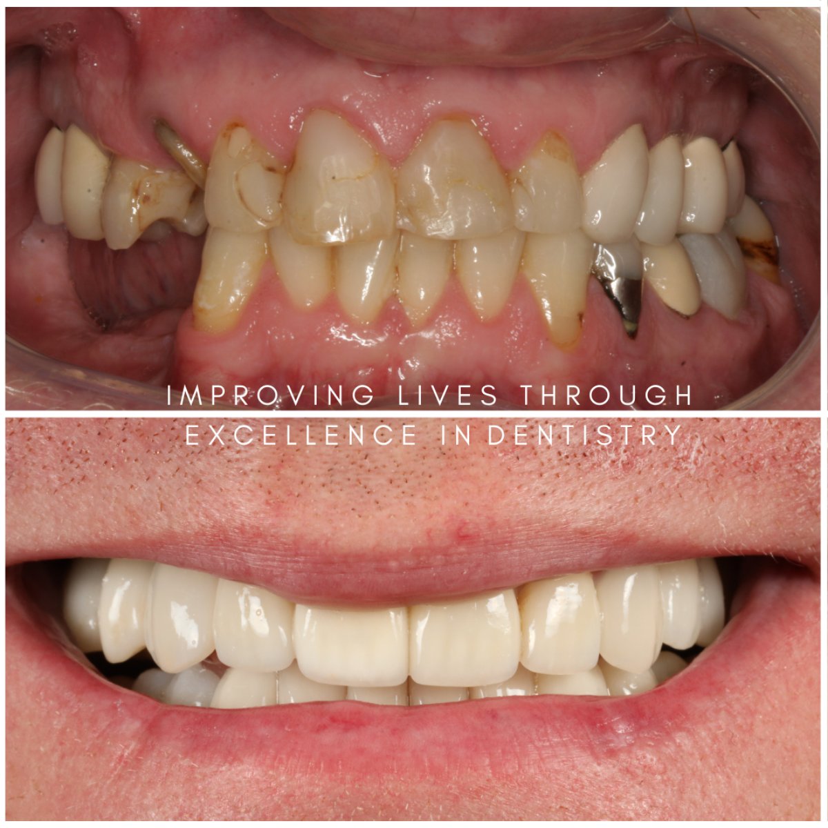 Smile Makeover