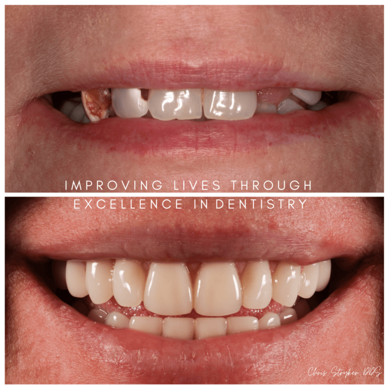 Dentures Lincoln Crossings Dental Care