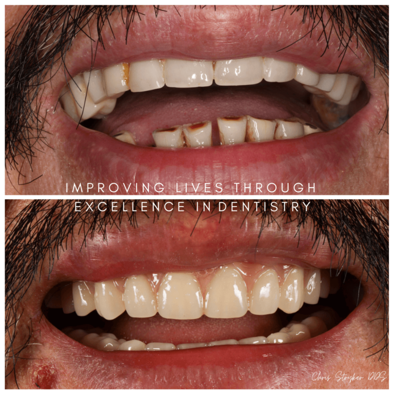 Dentures Lincoln Crossings Dental Care