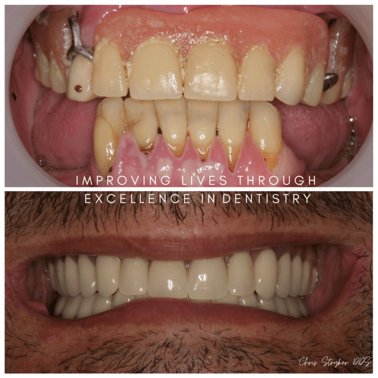 Dentures Lincoln Crossings Dental Care