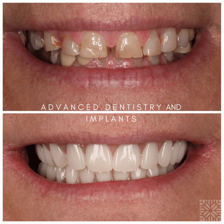 Implant Dentures Lincoln Crossings Dental Care